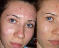 Чистка лица у косметолога с фото до и после и отзывами посетителей косметологий